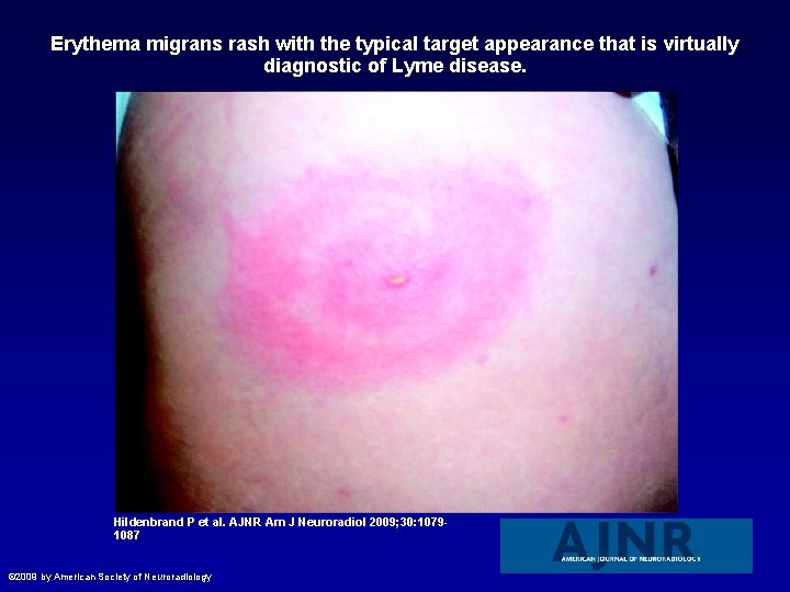 Erythema migrans rash with the typical target appearance that is virtually diagnostic of Lyme