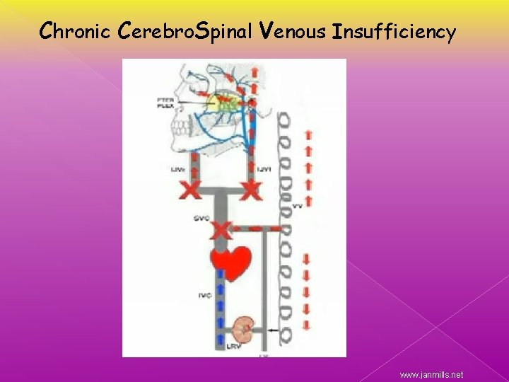 Chronic Cerebro. Spinal Venous Insufficiency www. janmills. net 