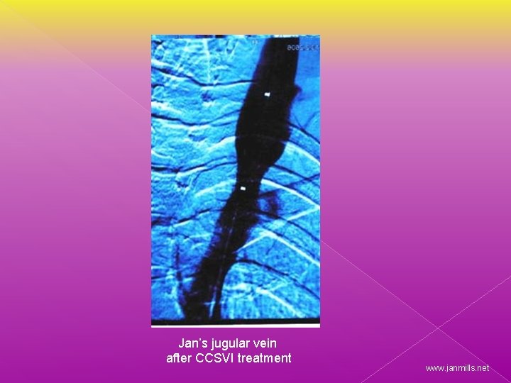 Jan’s jugular vein after CCSVI treatment www. janmills. net 