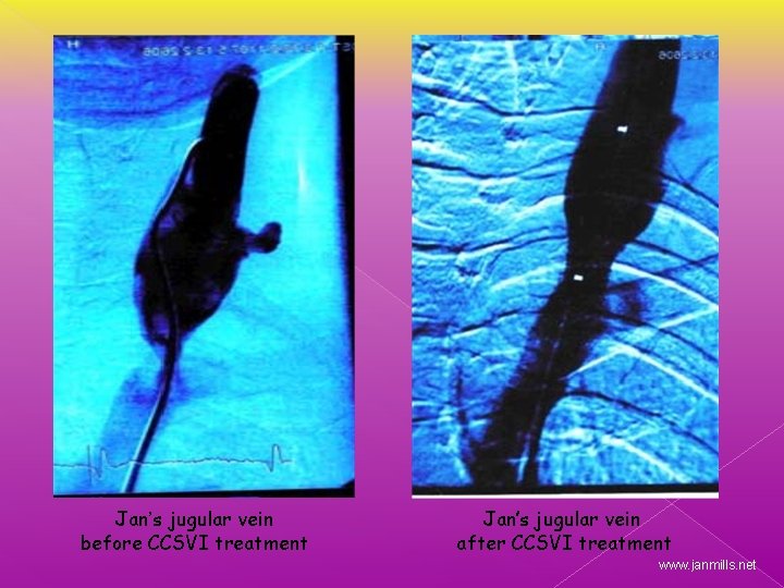 Jan’s jugular vein before CCSVI treatment Jan’s jugular vein after CCSVI treatment www. janmills.