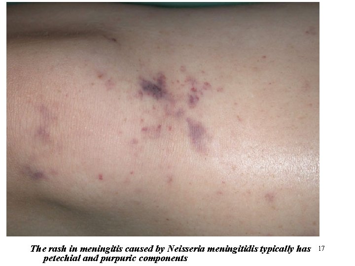 The rash in meningitis caused by Neisseria meningitidis typically has petechial and purpuric components