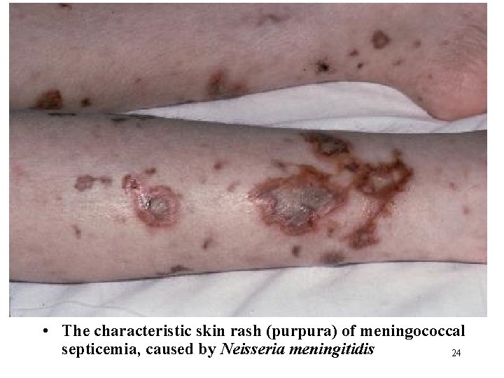  • The characteristic skin rash (purpura) of meningococcal septicemia, caused by Neisseria meningitidis