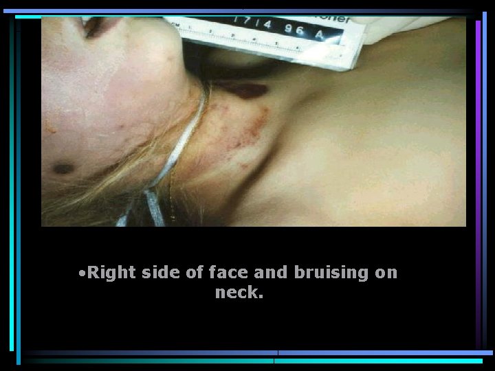  • Right side of face and bruising on neck. 