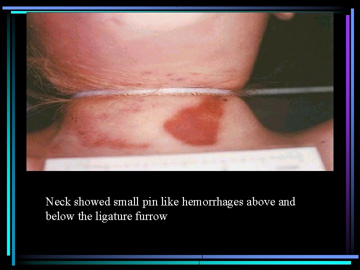 Neck showed small pin like hemorrhages above and below the ligature furrow 