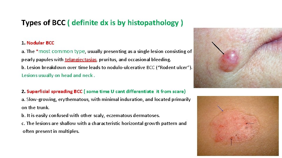 Types of BCC ( definite dx is by histopathology ) 1. Nodular BCC a.