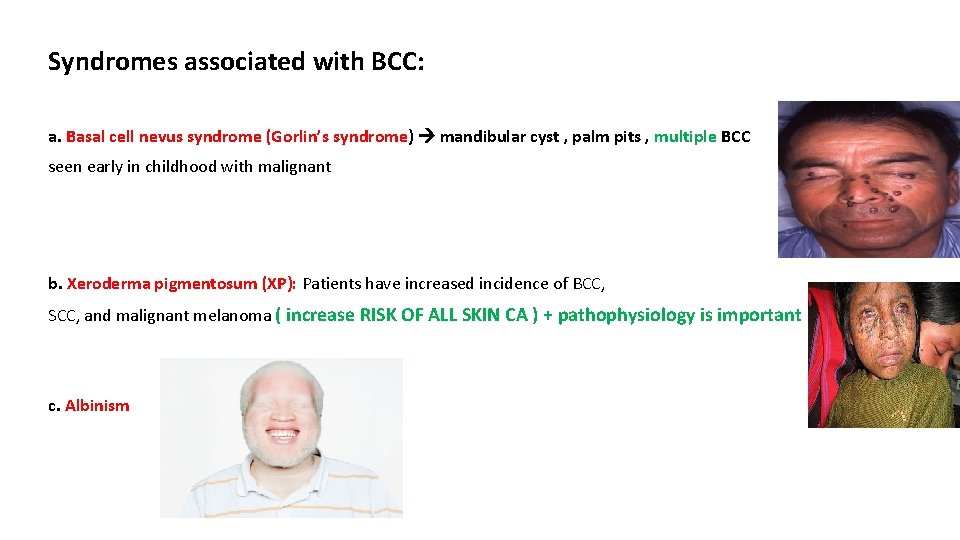 Syndromes associated with BCC: a. Basal cell nevus syndrome (Gorlin’s syndrome) mandibular cyst ,