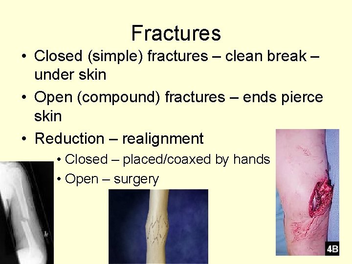 Fractures • Closed (simple) fractures – clean break – under skin • Open (compound)