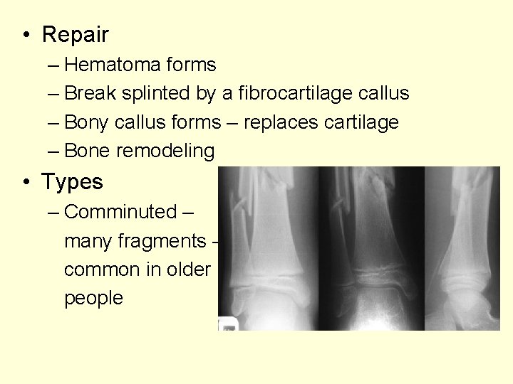  • Repair – Hematoma forms – Break splinted by a fibrocartilage callus –