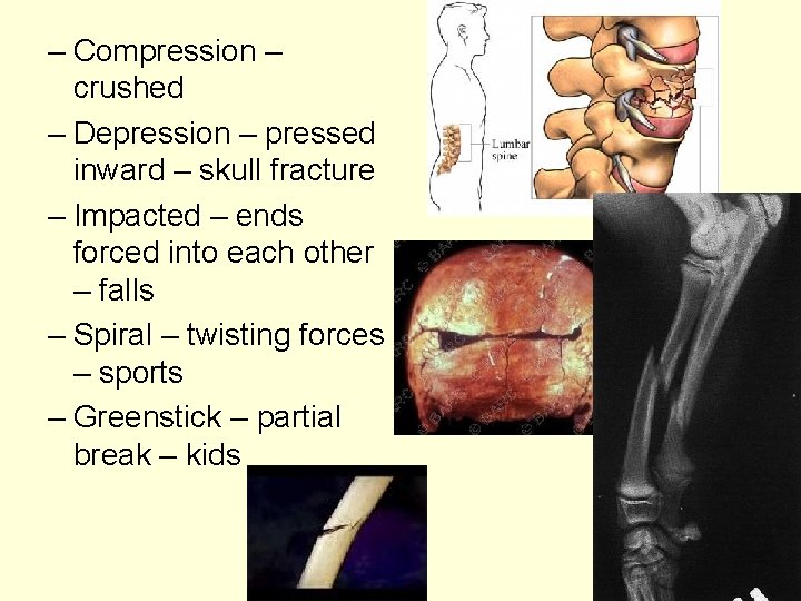 – Compression – crushed – Depression – pressed inward – skull fracture – Impacted