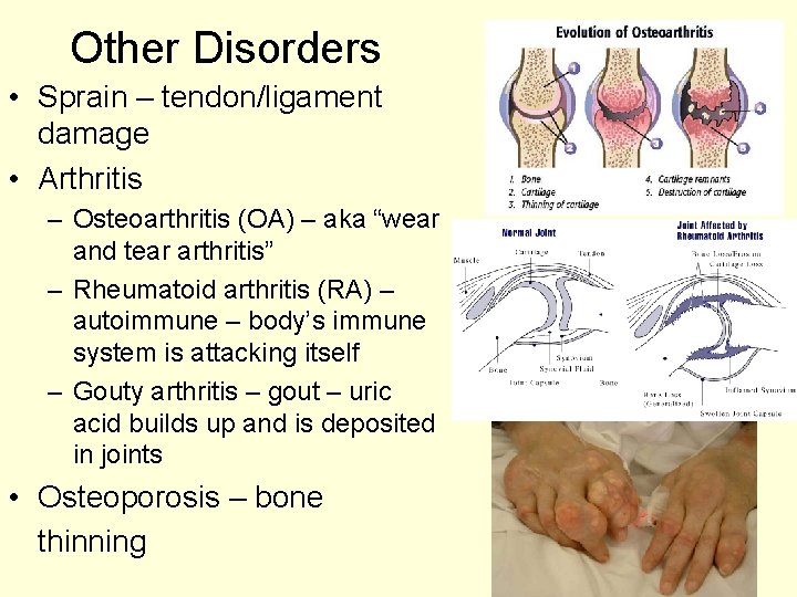 Other Disorders • Sprain – tendon/ligament damage • Arthritis – Osteoarthritis (OA) – aka