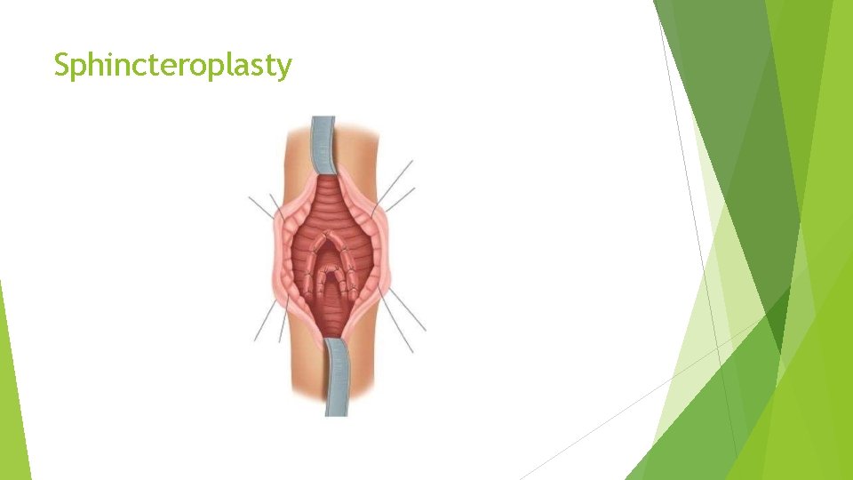 Sphincteroplasty 