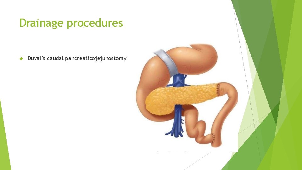 Drainage procedures Duval’s caudal pancreaticojejunostomy 