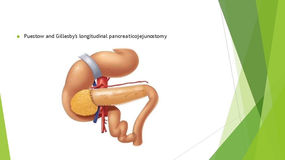  Puestow and Gillesby's longitudinal pancreaticojejunostomy 