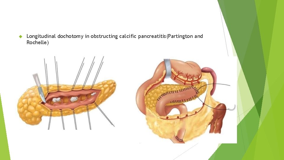  Longitudinal dochotomy in obstructing calcific pancreatitis(Partington and Rochelle) 