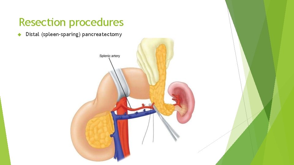 Resection procedures Distal (spleen-sparing) pancreatectomy 