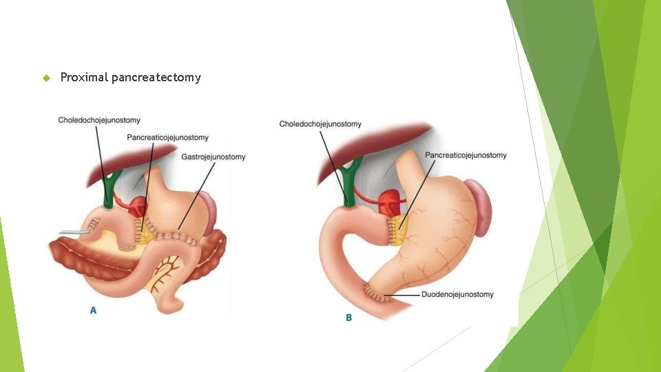  Proximal pancreatectomy 