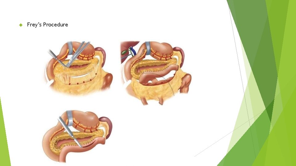  Frey’s Procedure 