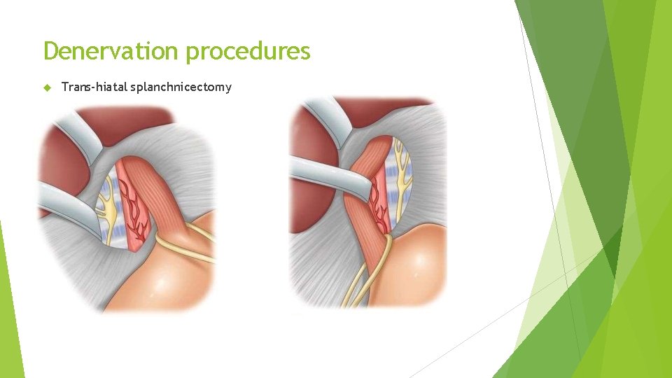 Denervation procedures Trans-hiatal splanchnicectomy 