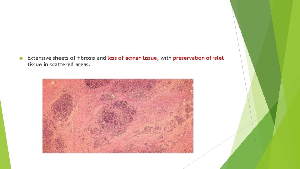  Extensive sheets of fibrosis and loss of acinar tissue, with preservation of islet