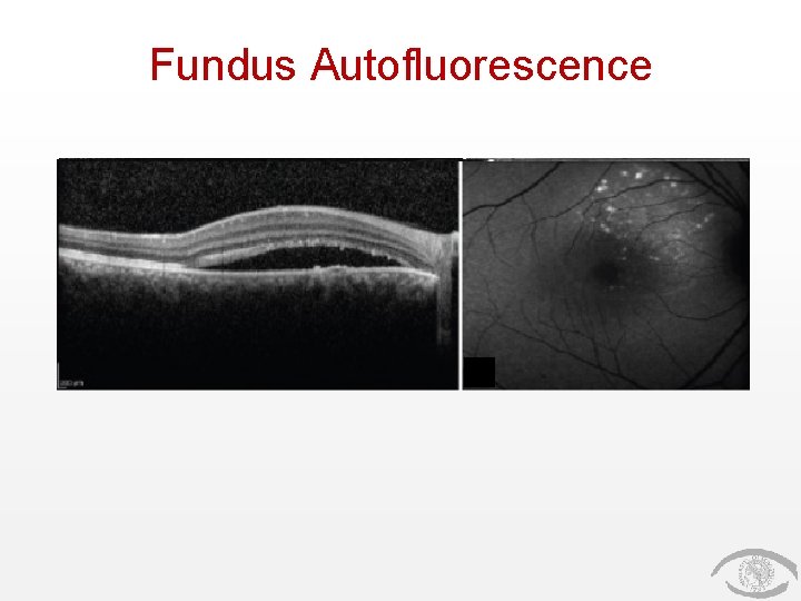 Fundus Autofluorescence 