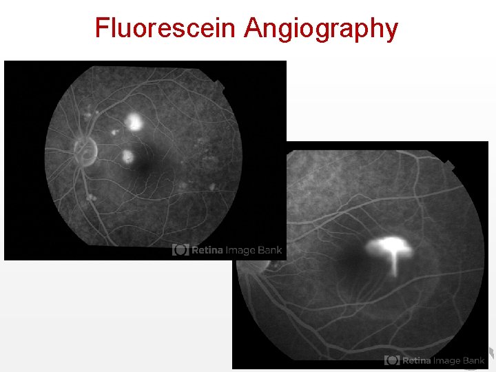 Fluorescein Angiography 