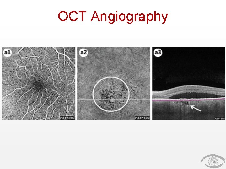 OCT Angiography 
