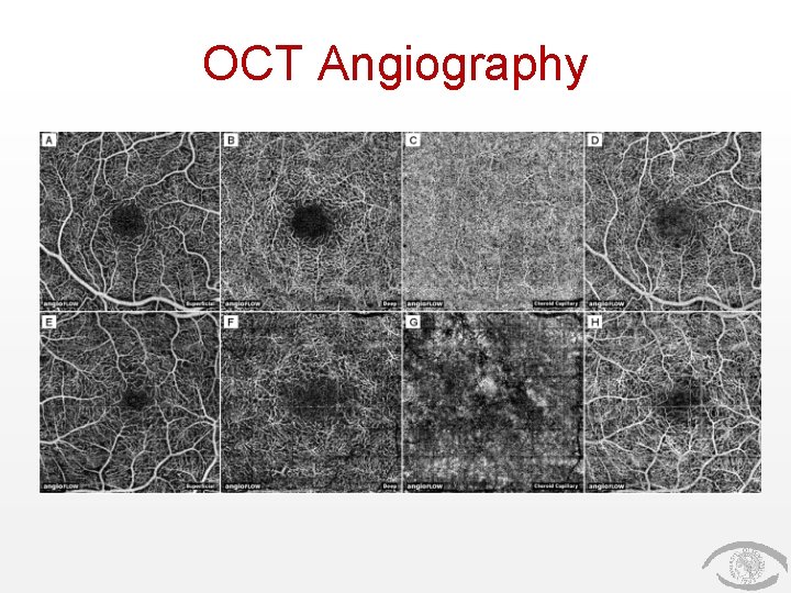 OCT Angiography 