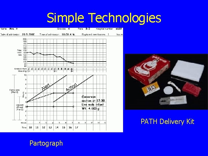 Simple Technologies PATH Delivery Kit Partograph 