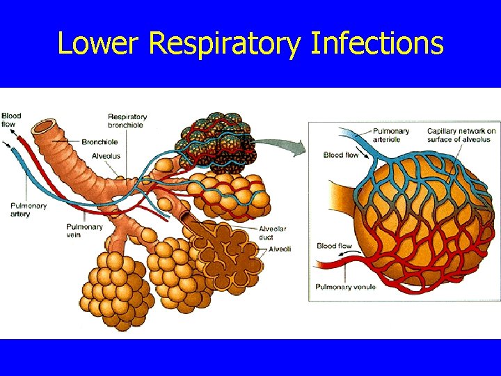 Lower Respiratory Infections 