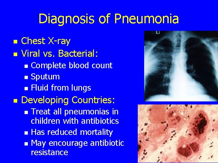 Diagnosis of Pneumonia n n Chest X-ray Viral vs. Bacterial: n n Complete blood