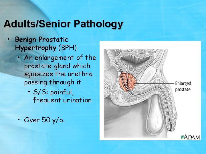 Adults/Senior Pathology • Benign Prostatic Hypertrophy (BPH) • An enlargement of the prostate gland
