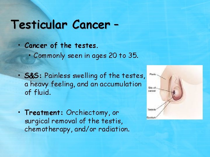 Testicular Cancer – • Cancer of the testes. • Commonly seen in ages 20