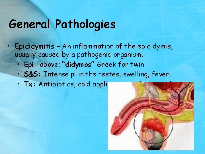 General Pathologies • Epididymitis – An inflammation of the epididymis, usually caused by a