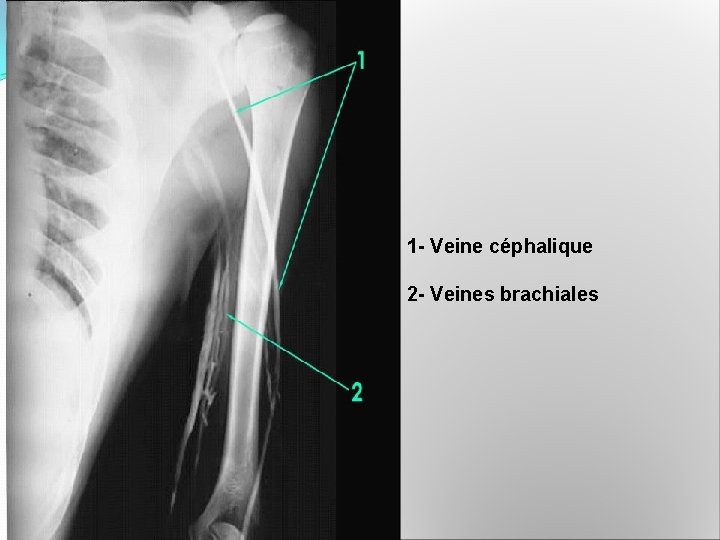 1 - Veine céphalique 2 - Veines brachiales 