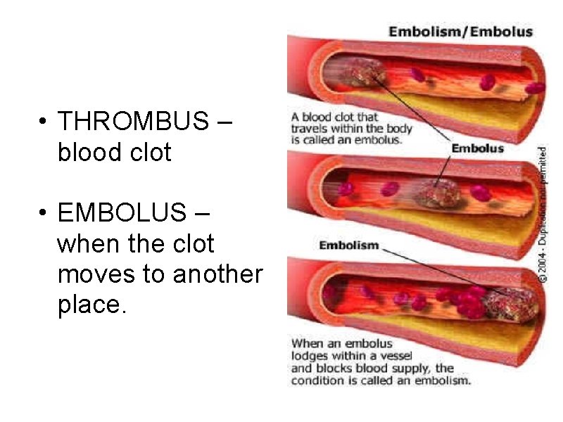  • THROMBUS – blood clot • EMBOLUS – when the clot moves to