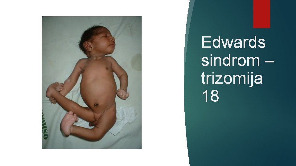 Edwards sindrom – trizomija 18 