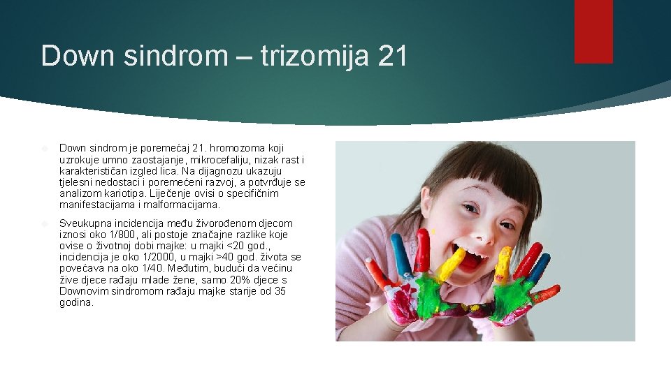 Down sindrom – trizomija 21 Down sindrom je poremećaj 21. hromozoma koji uzrokuje umno