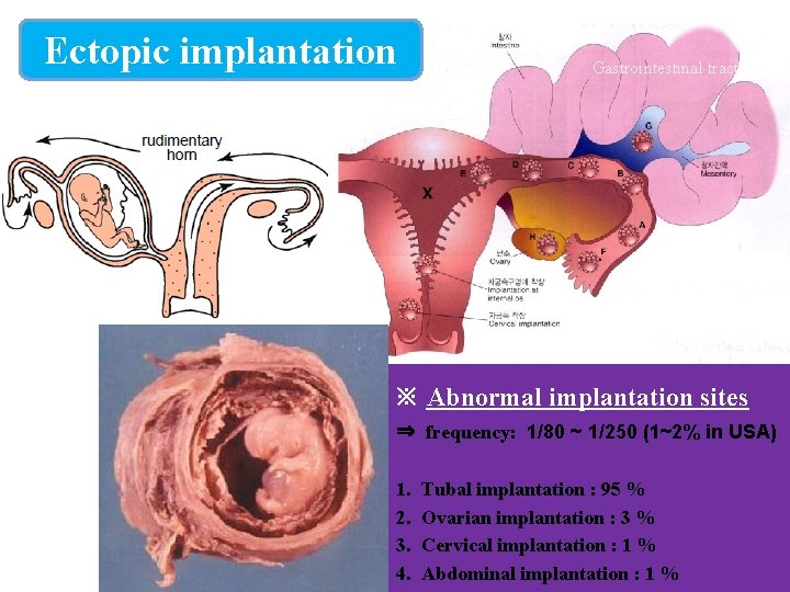 Ectopic implantation Gastrointestinal tract ※ Abnormal implantation sites ⇒ frequency: 1/80 ~ 1/250 (1~2%