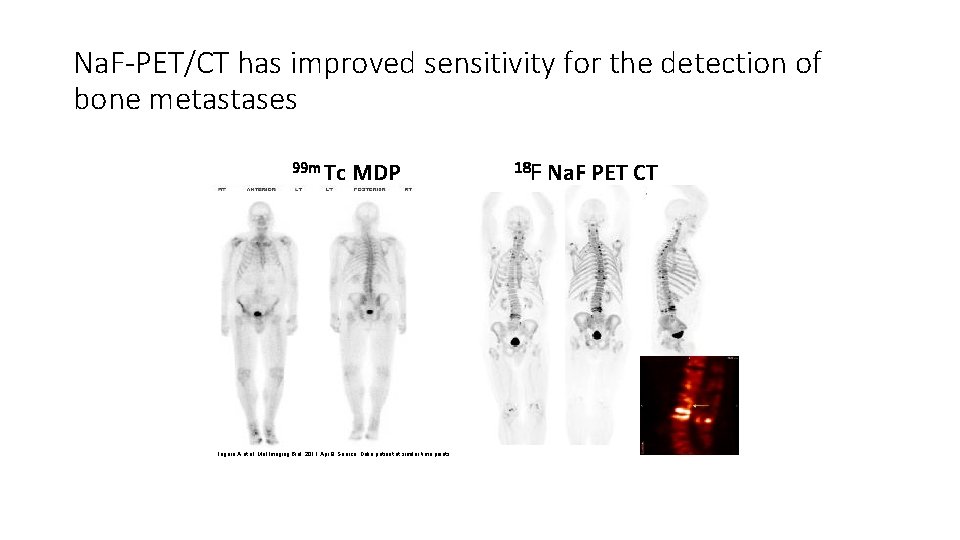 Na. F-PET/CT has improved sensitivity for the detection of bone metastases 99 m Tc