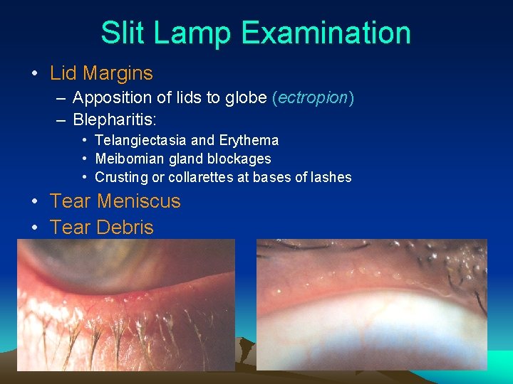 Slit Lamp Examination • Lid Margins – Apposition of lids to globe (ectropion) –