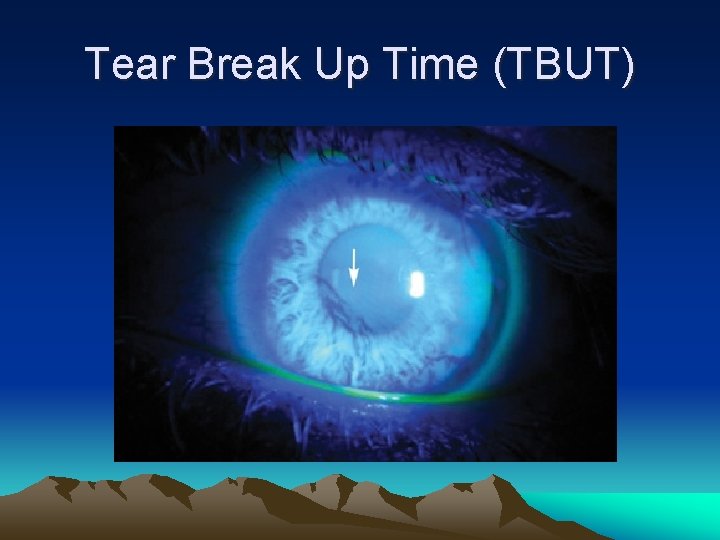 Tear Break Up Time (TBUT) 