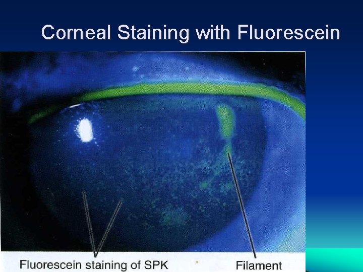 Corneal Staining with Fluorescein 