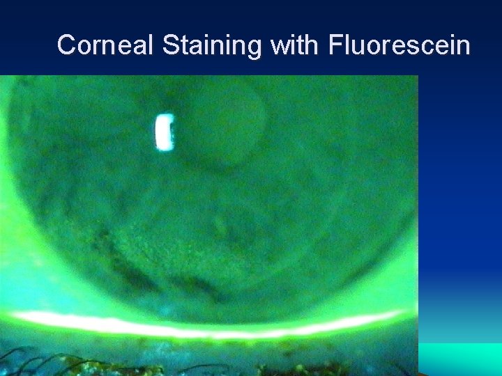 Corneal Staining with Fluorescein 