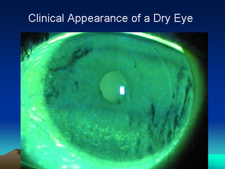 Clinical Appearance of a Dry Eye 