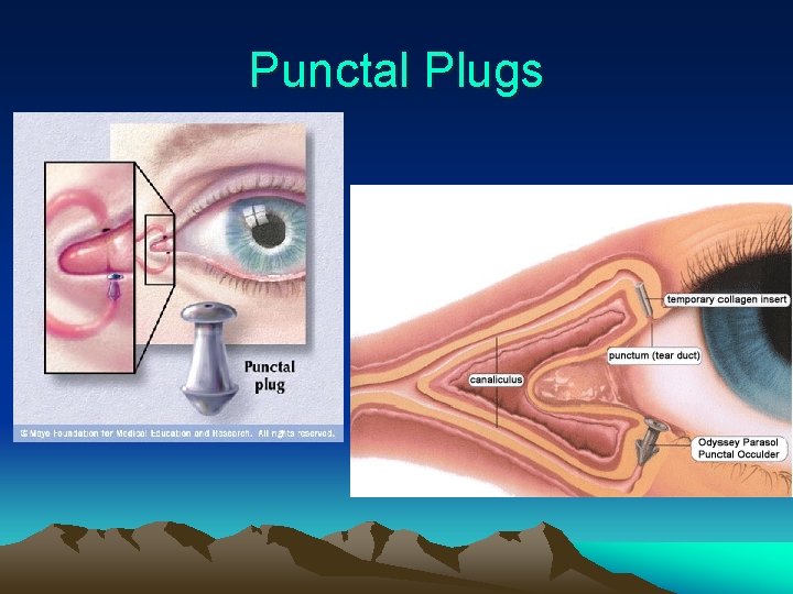 Punctal Plugs 