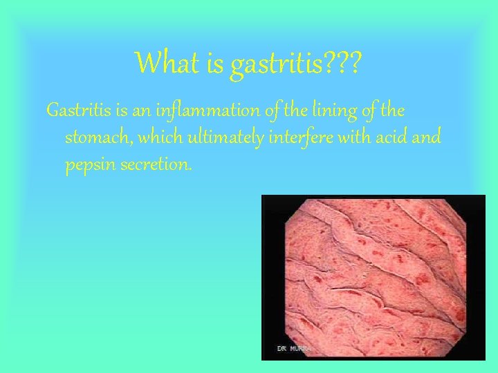 What is gastritis? ? ? Gastritis is an inflammation of the lining of the
