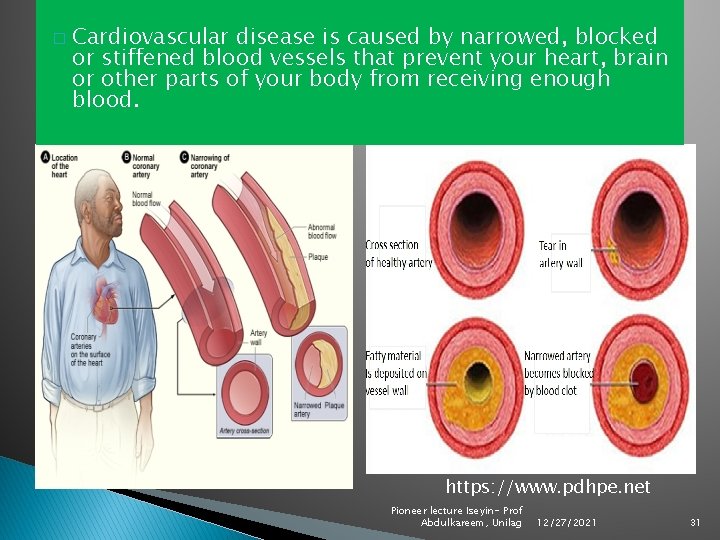 � Cardiovascular disease is caused by narrowed, blocked or stiffened blood vessels that prevent