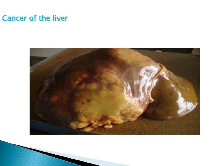 Cancer of the liver Pioneer lecture Iseyin- Prof Abdulkareem, Unilag 12/27/2021 4 9 