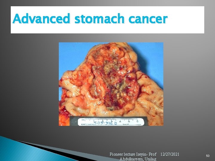 Advanced stomach cancer Pioneer lecture Iseyin- Prof Abdulkareem, Unilag 12/27/2021 50 