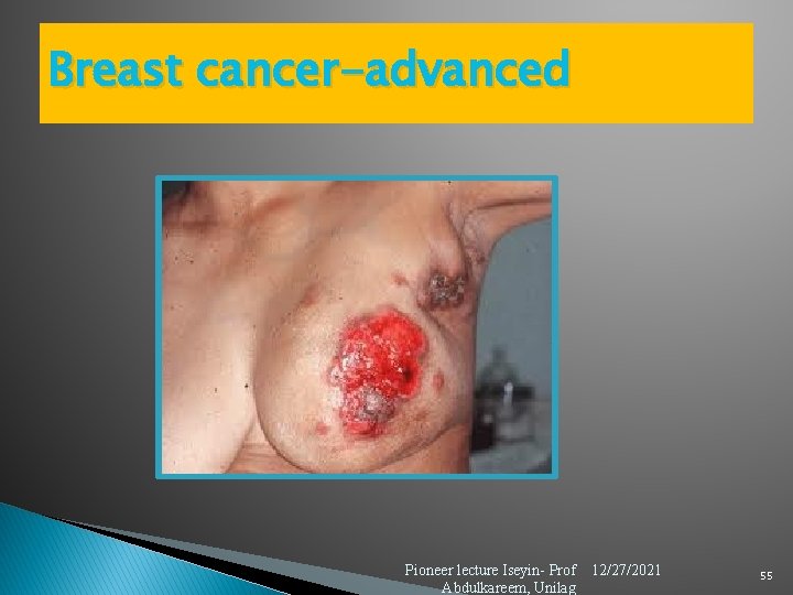 Breast cancer-advanced Pioneer lecture Iseyin- Prof Abdulkareem, Unilag 12/27/2021 55 